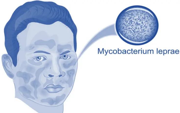 Leprosy 