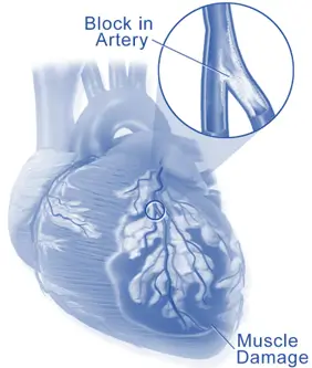 Myocardial infarction Myocardial infarction (MI)