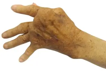 Rheumatoid Rheumatoid