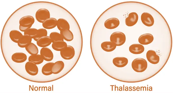 alpha and beta thalassemia