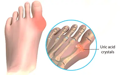 Gout Disease Gout Disease