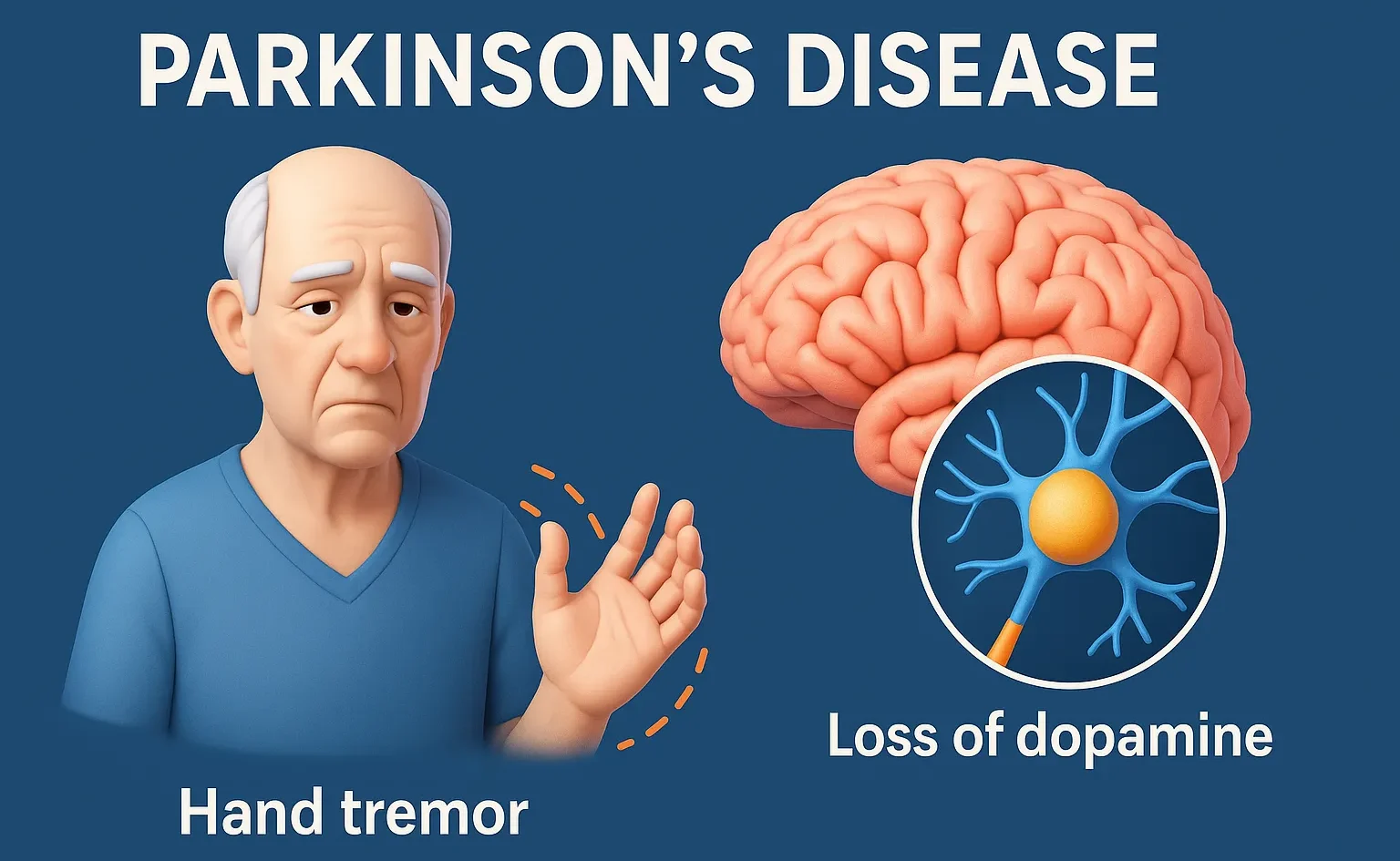 Parkinson’s Disease (PD)
